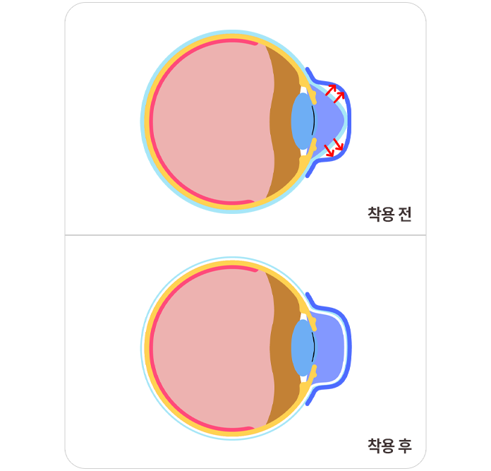 기미색소1